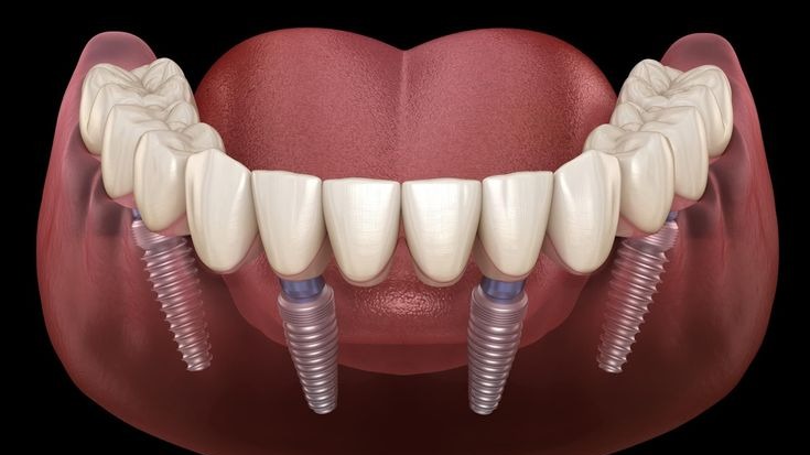 Dental Implants Clinic in Punawale,  Dental Implants Clinic Pune,  Dental Implants in Punawale,  Tooth Implant Clinic Punawale,  Dental Implant Specialist Pune,  Best Dental Implants Clinic in Punawale,  Dental Implant Treatment Pune,  Missing Teeth Replacement Pune,  Permanent Dental Implants Pune,  DR Hileri Mori