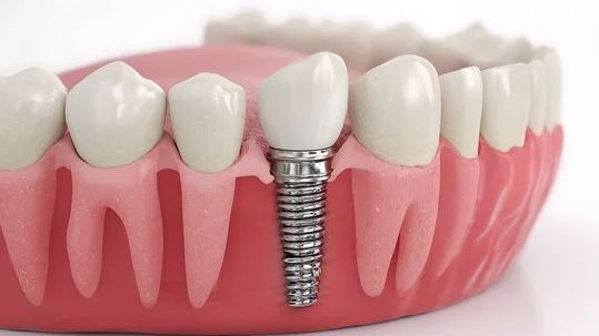 Best Implant Dentist in Punawale,  Implant Dentist in Punawale,  Dental Implants Punawale,  Dental Implant Clinic Punawale,  Tooth Implant Specialist Pune,  Dental Implant Treatment Pune,  Missing Teeth Replacement Pune,  Full Mouth Dental Implants Pune,  Single Tooth Implant Pune,  Dr. Hileri Mori Pune