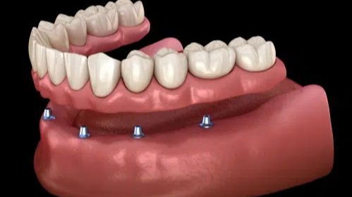Implants for Missing Teeth,  Implants for Missing Teeth in Pune,  Dental Implants in Pune,  Dental Implants for Missing Teeth,  Missing Teeth Treatment in Pune,  Missing Tooth Replacement Pune,  Tooth Replacement in Pune,  Best Dental Implants in Pune,  Expert Dental Implants in Pune,  Trusted Dental Implants in Pune