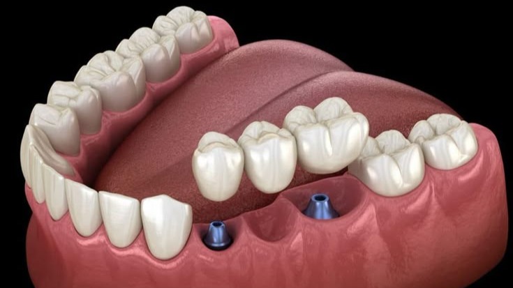 Front teeth correction,  Front teeth correction Pune,  Front teeth correction treatment Pune,  Front teeth correction dentist Pune,  Front teeth alignment Pune,  Front teeth correction specialist Pune,  Front teeth aesthetic treatment Pune,  smile correction Pune,  dental aesthetics Pune,  Dr. Hileri Mori Pune