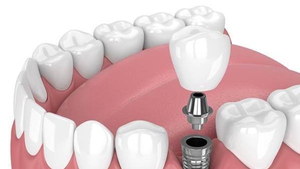full mouth dental implants,  full mouth dental implants Pune,  full mouth dental implants in Pune,  full mouth dental implants dentist Pune,  full mouth dental implant specialist Pune,  full mouth dental implants treatment Pune,  full mouth teeth replacement Pune,  dental implants Pune,  Dr. Hileri Mori,  full teeth replacement Pune
