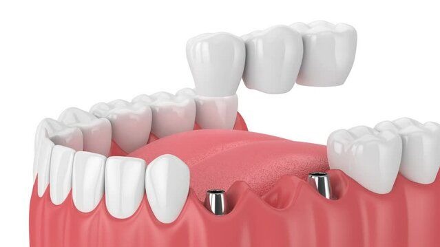 full mouth implant cost Pune,  full mouth dental implants Pune,  full mouth implants Pune,  dental implant cost Pune,  full mouth teeth replacement Pune,  full arch dental implants Pune,  dental implants Pune,  implant dentist Pune,  full mouth rehabilitation Pune,  Dr. Hileri Mori